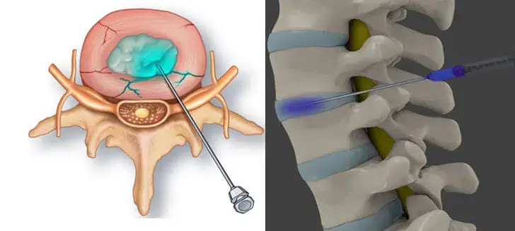 Clinician administering ozone nucleolysis to the targeted area of the spine