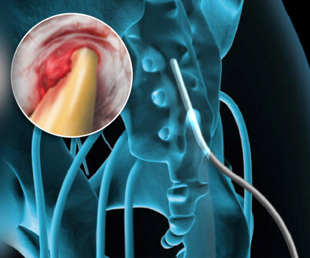 Clinician inserting the epiduroscope into the epidural space