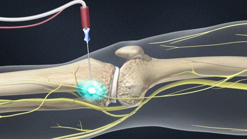 Clinician marking the injection site for nerve denervation