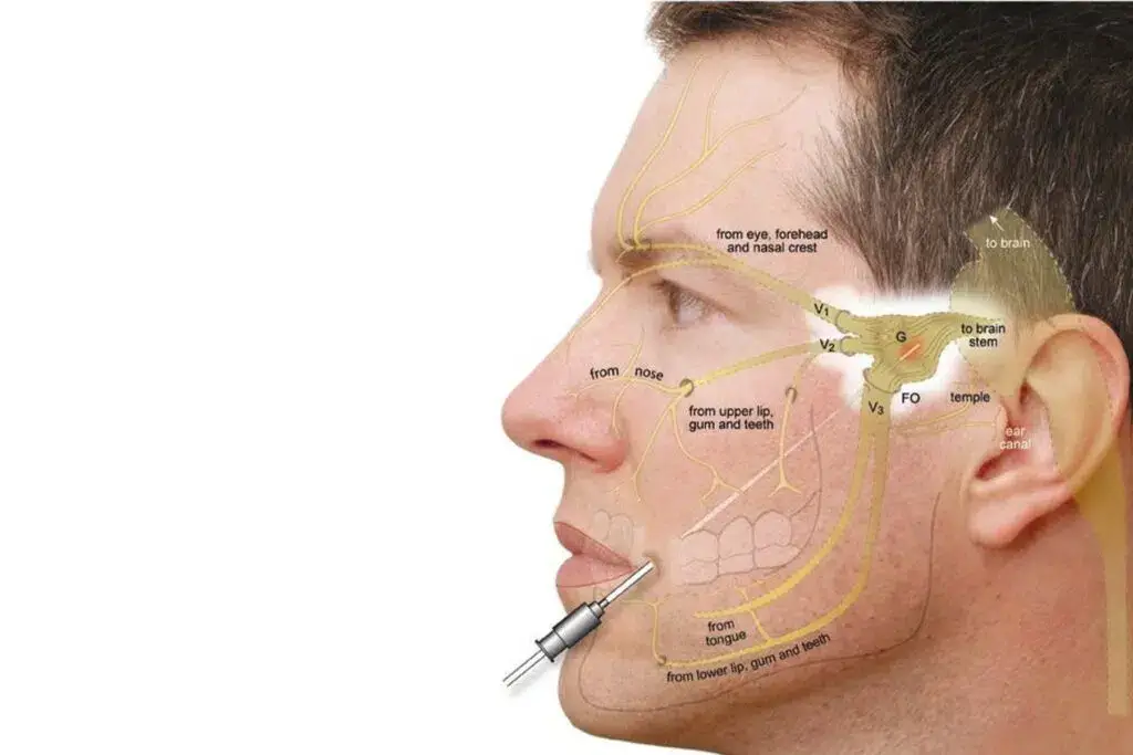 Close-up of the facial area being prepared for Trigeminal RF