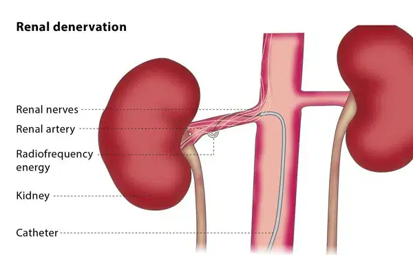 Close-up of the needle being inserted for the nerve denervation procedure