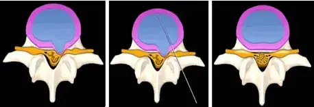 Close-up of the spine highlighting the injection site for ozone nucleolysis