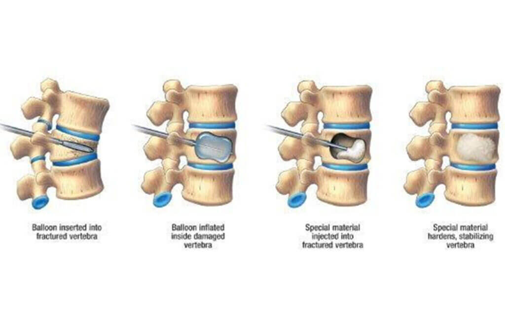 Close-up of the spine, highlighting the injection site for vertebroplasty