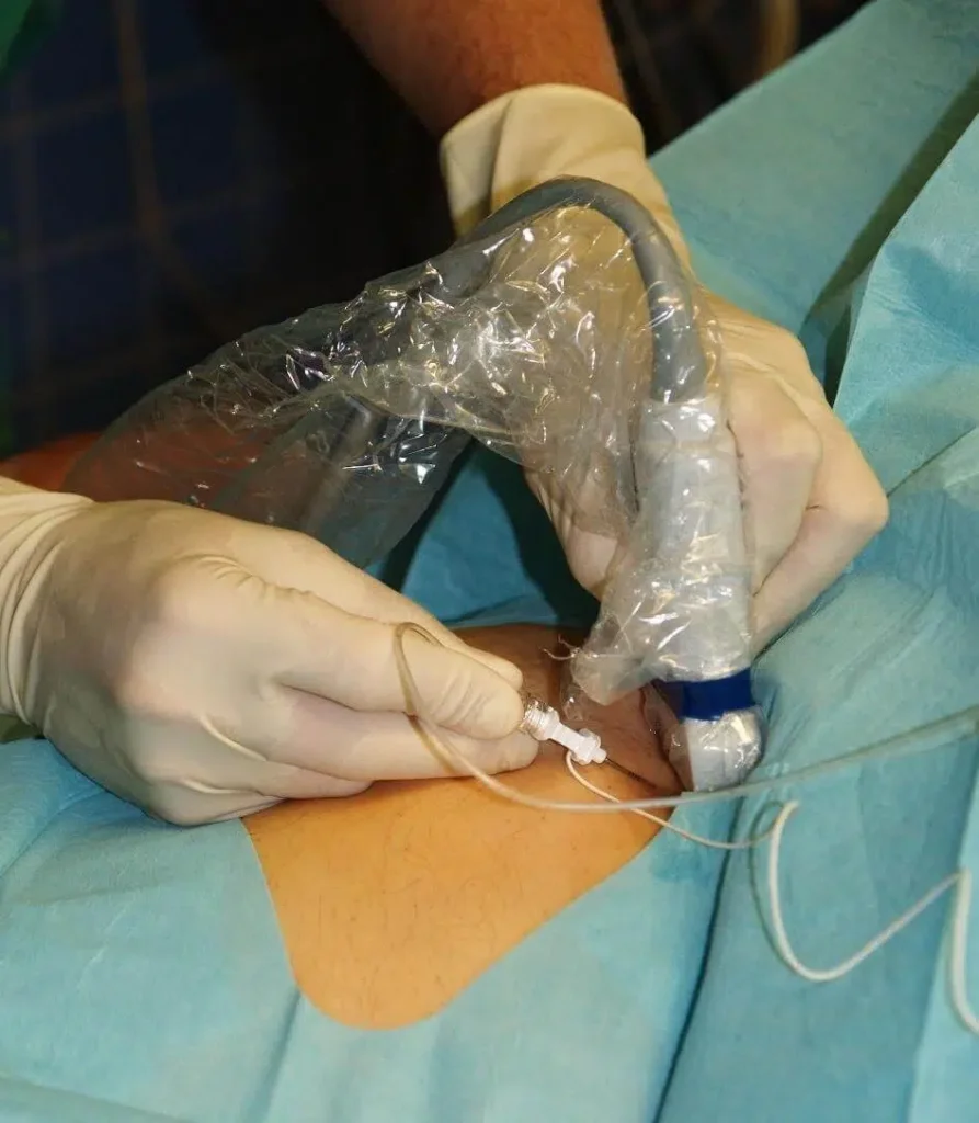 Close-up of the targeted area for the nerve block injection