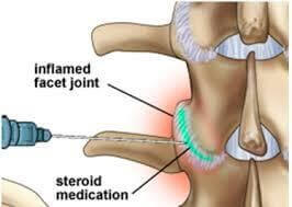 Illustration explaining post-injection care after a facet joint injection