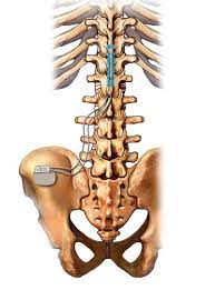 Illustration of post-procedure care for spinal cord stimulation therapy patients