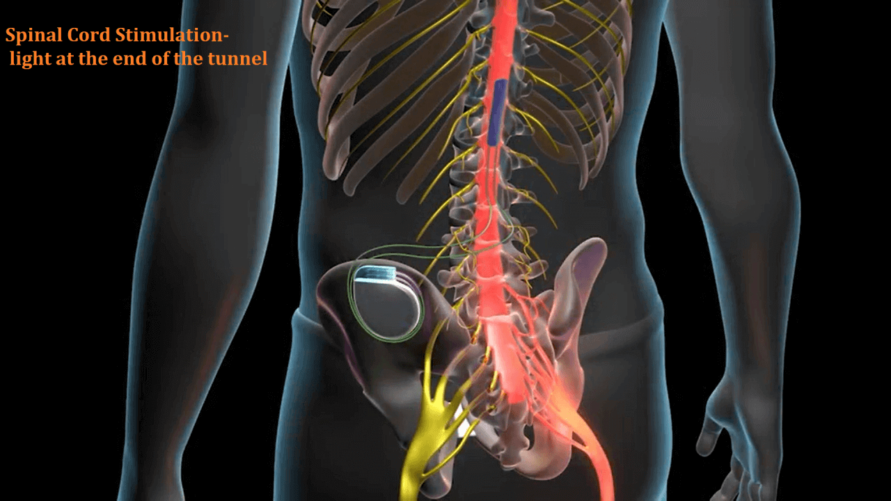 Patient positioned for spinal cord stimulation therapy at Indo British Advanced Pain Clinic