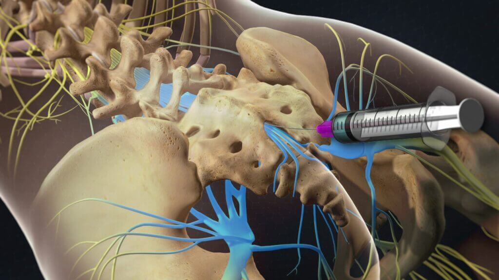 technique of administering a caudal epidural injection