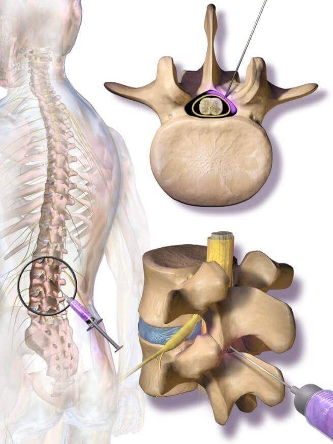 Close-up of the injection site for epidural spinal injections