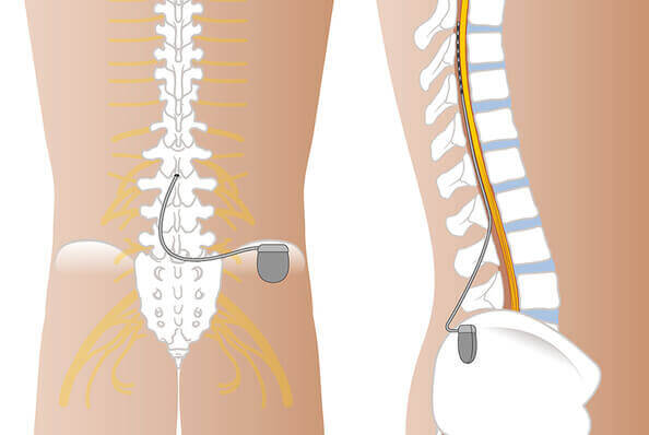 Spinal Cord Stimulation Therapy in Ibap non surgical procedure