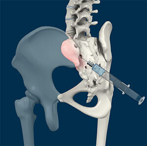 sacroilliac-joint-injection pain relief procedure at ibapclinics