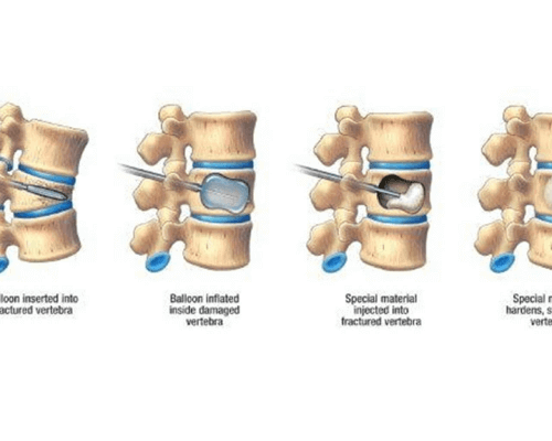 vertebroplastry Procedure in Ibap non surgical pain relief